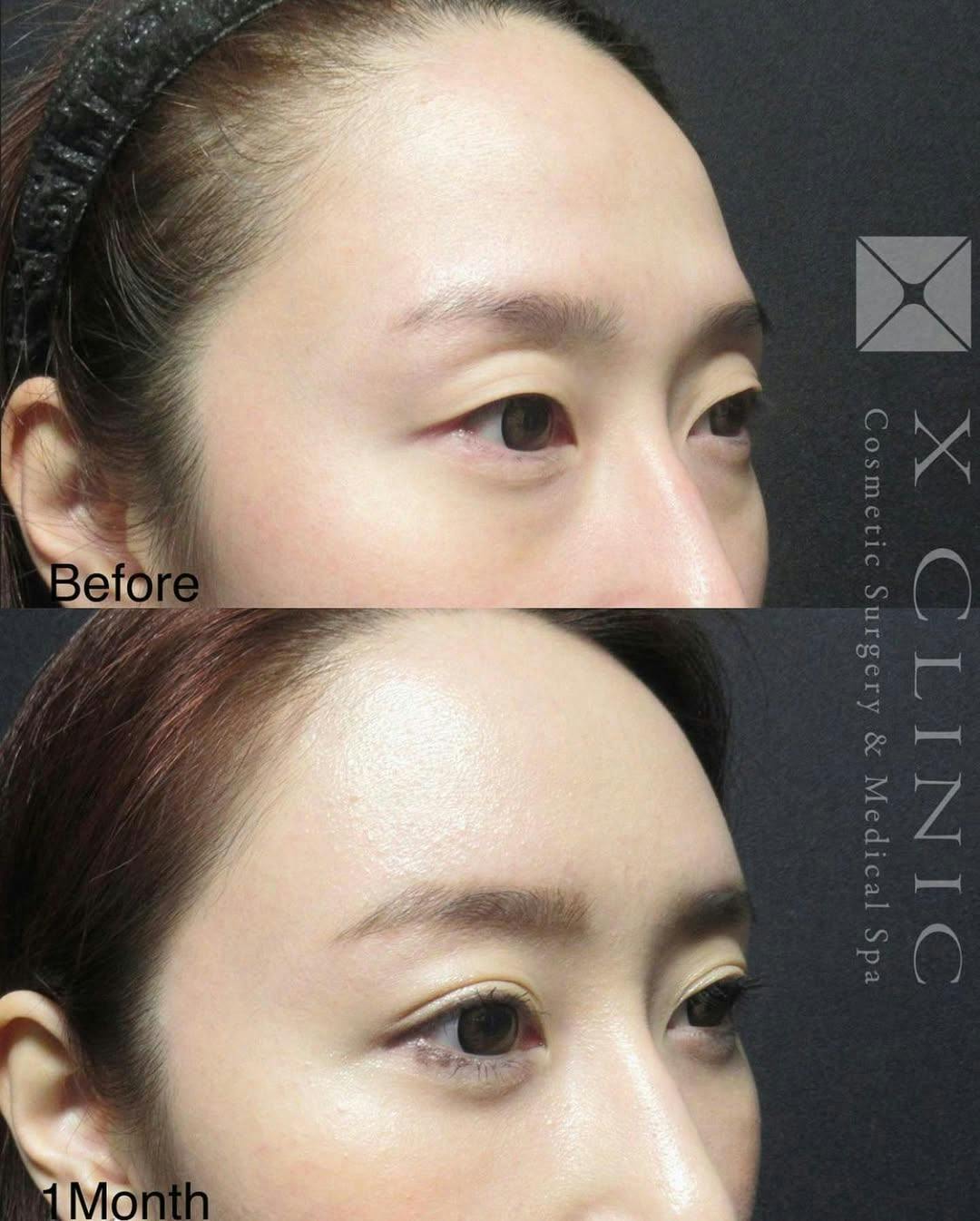 【女性・目元】クマ取りフルコース 額こめかみ目の上脂肪注入 Xクロスダブル_before_aftar