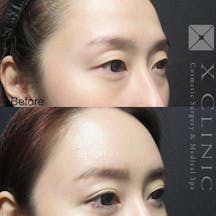 【女性・目元】クマ取りフルコース 額こめかみ目の上脂肪注入 Xクロスダブル_before_aftar