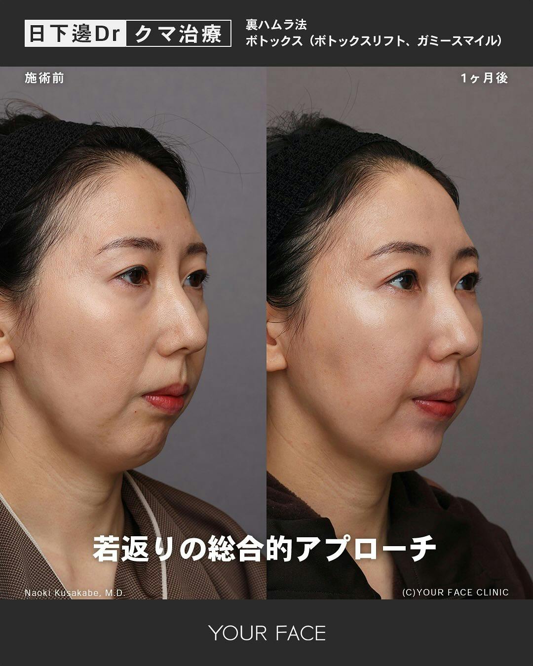 ボトックス注射ができる美容クリニックの症例写真・ビフォーアフター・経過写真一覧, image size:1080x1350