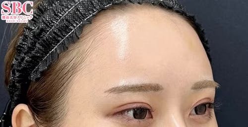 【20代女性・額・こめかみ】コンデンスリッチフェイス法(額・こめかみ脂肪注入)・ナチュラル脂肪注射・ナチュラル脂肪注射コンデンスリッチ_after