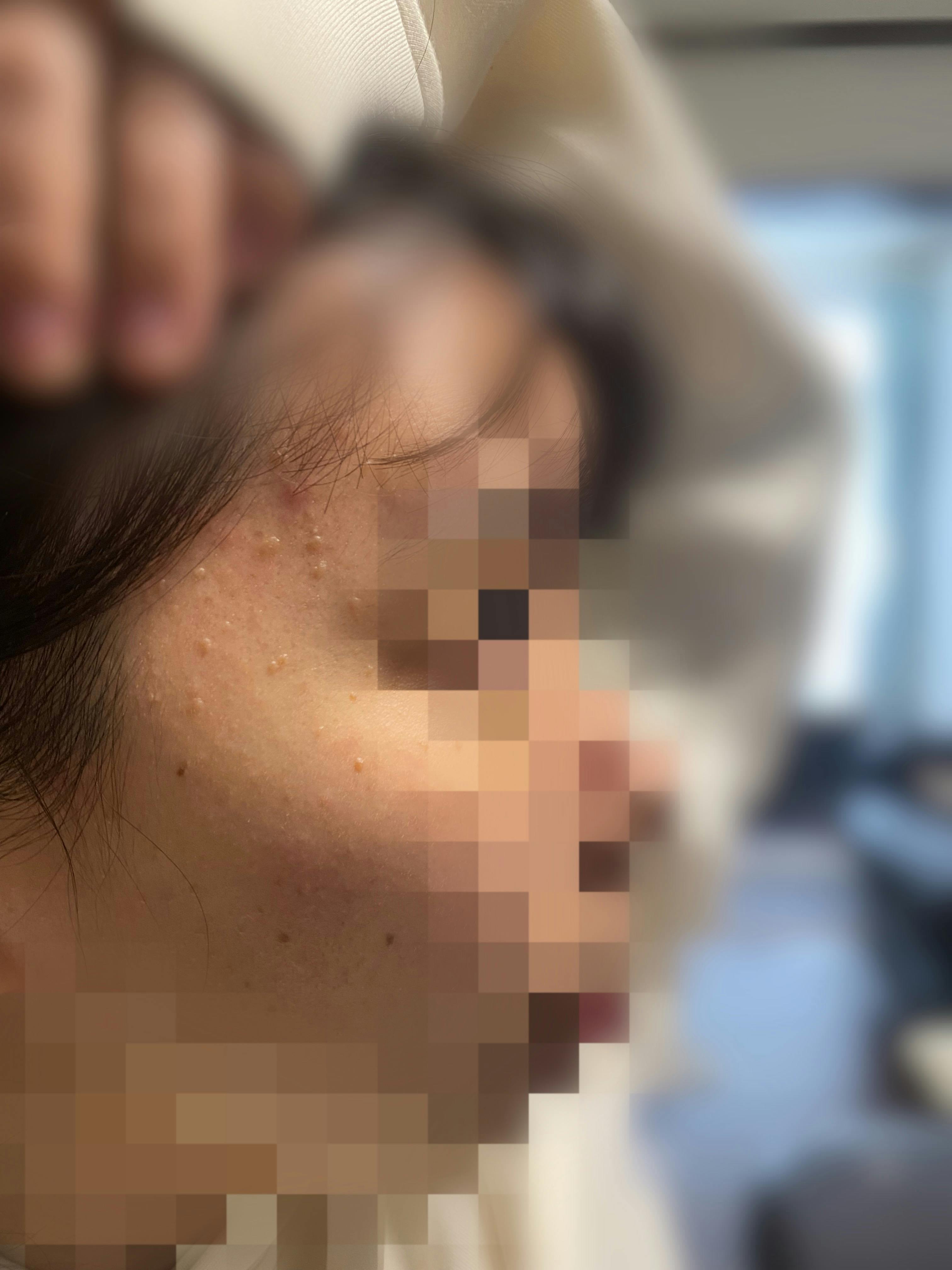 Jスキンクリニック(JSKINクリニック)でほくろ・いぼ除去を受けたなるとよさんの写真