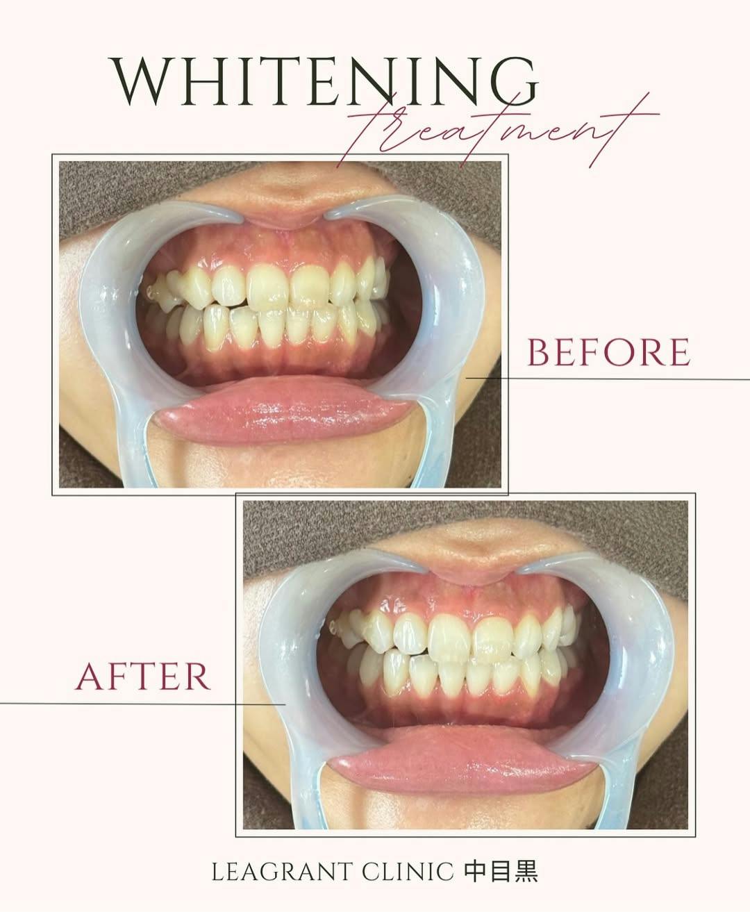 【20代女性・歯】ポリリンホワイトニング_before_aftar