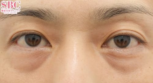 【40代・たるみ】目の下の切らないクマ・たるみ（ふくらみ）取り ナチュラル脂肪注射コンデンスリッチ ナチュラル脂肪注射ナノリッチ_before