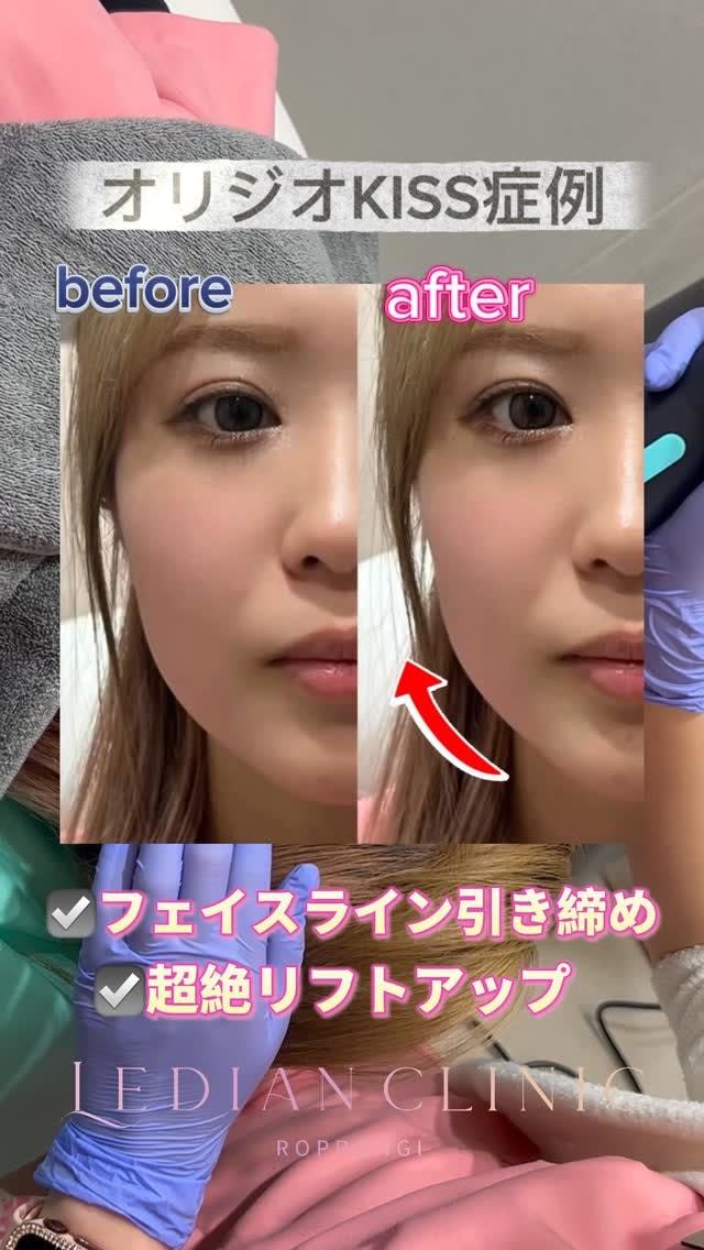 【女性・たるみ】オリジオKISS_before_aftar
