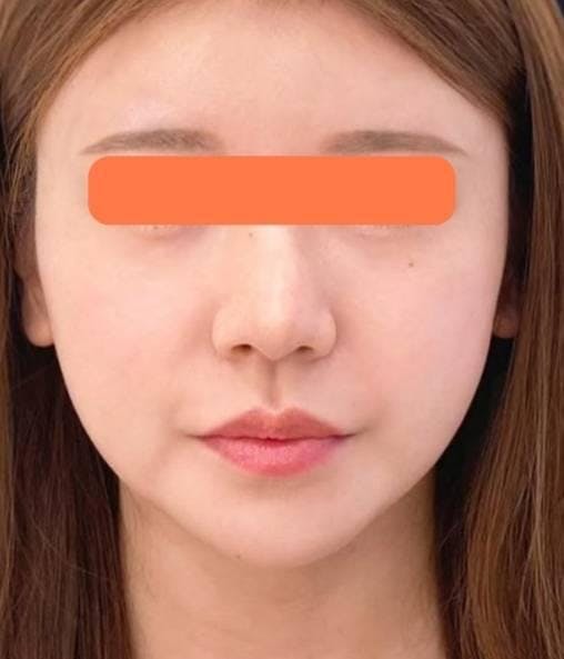 美容皮膚科タカミクリニック シミ・美肌育成外来でたるみ治療：サーマクールCPTを受けたKANACoさんの写真