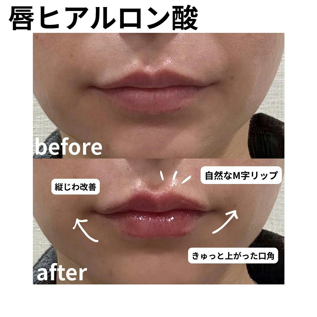 【女性・唇】ヒアルロン酸_before_aftar