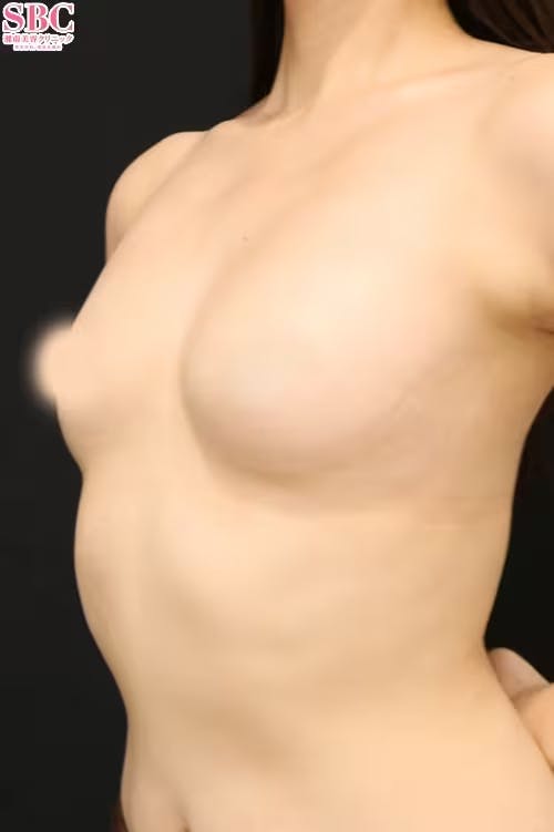 【30代前半女性・胸】セルーション(脂肪注入豊胸)、コールマン式、3Dプレミアム注入法（垂直注入法）（脂肪注入豊胸オプション）_before