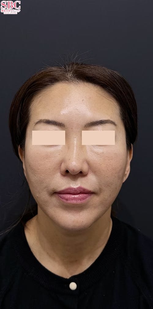 【女性・輪郭】VOV（ボブ）リフト、シークレットリフト、テスリフト_after