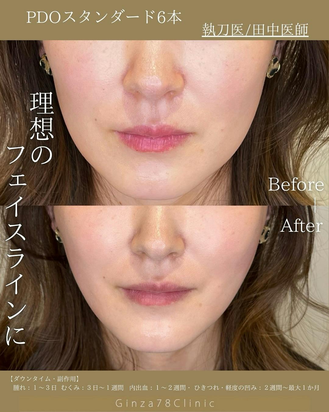 【女性・輪郭】糸リフト(PDOスタンダード)_before_aftar