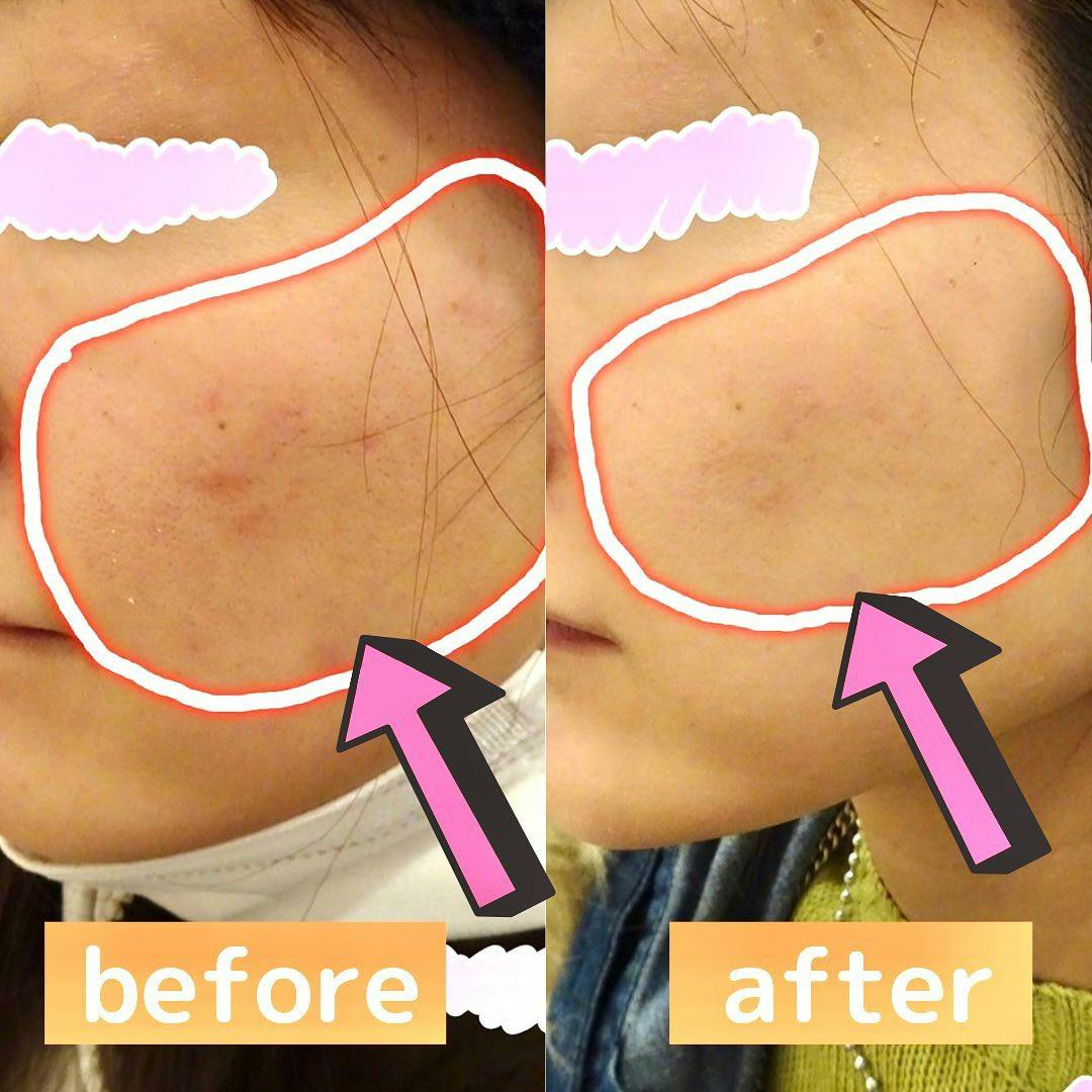 【女性・シミ】ピコレーザー_before_aftar