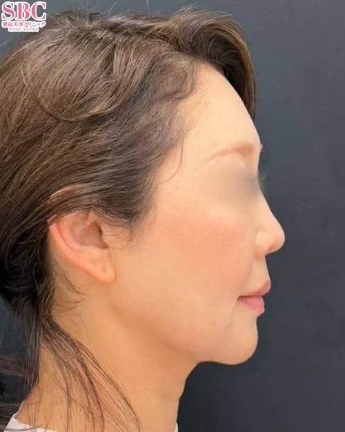 【女性・顔】小顔用脂肪吸引注射・エンブレイスRF・糸リフト_after