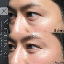 【男性・目元】クマ取りフルコース_before_aftar