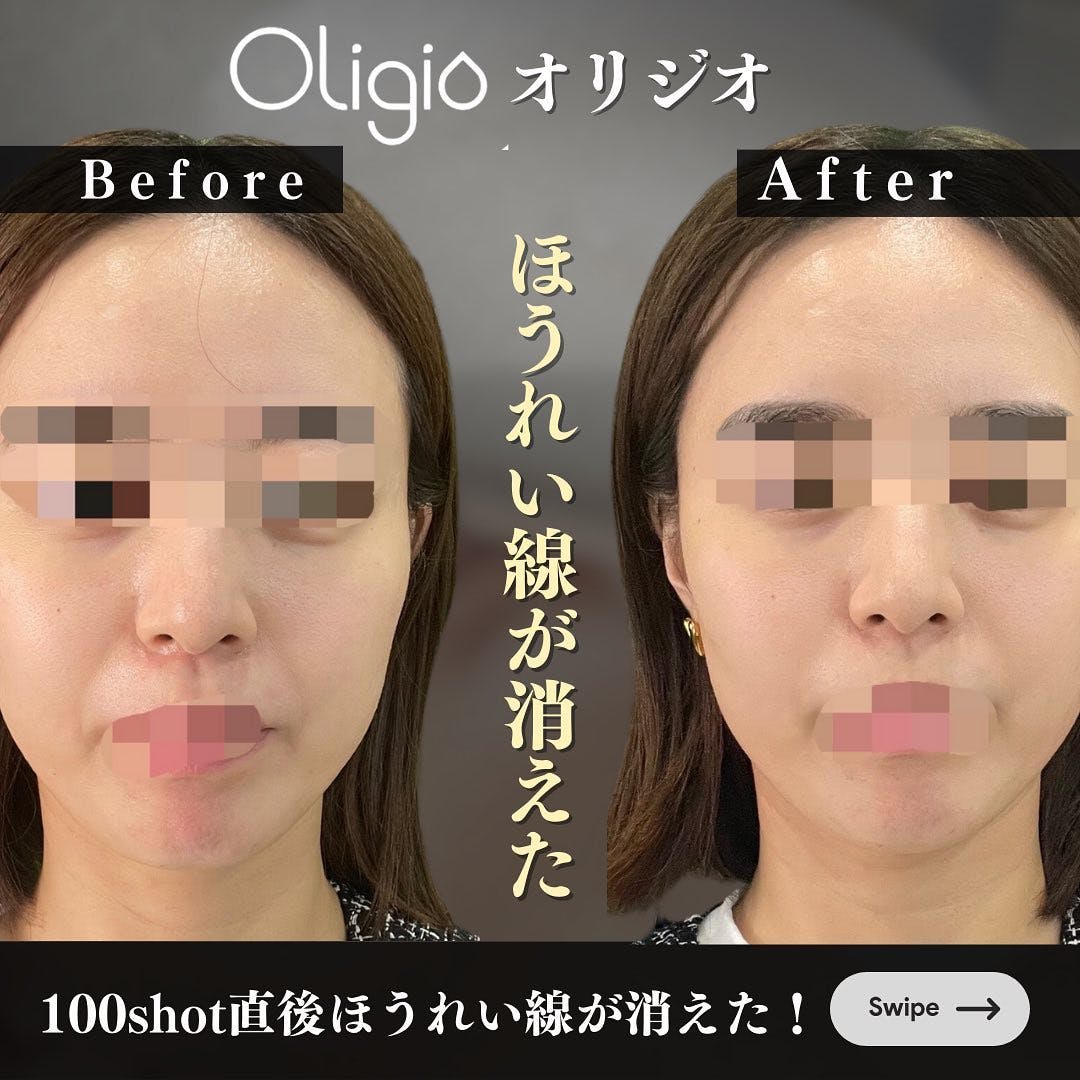 【女性・ほうれい線】Oligio(オリジオ):100shot_before_aftar