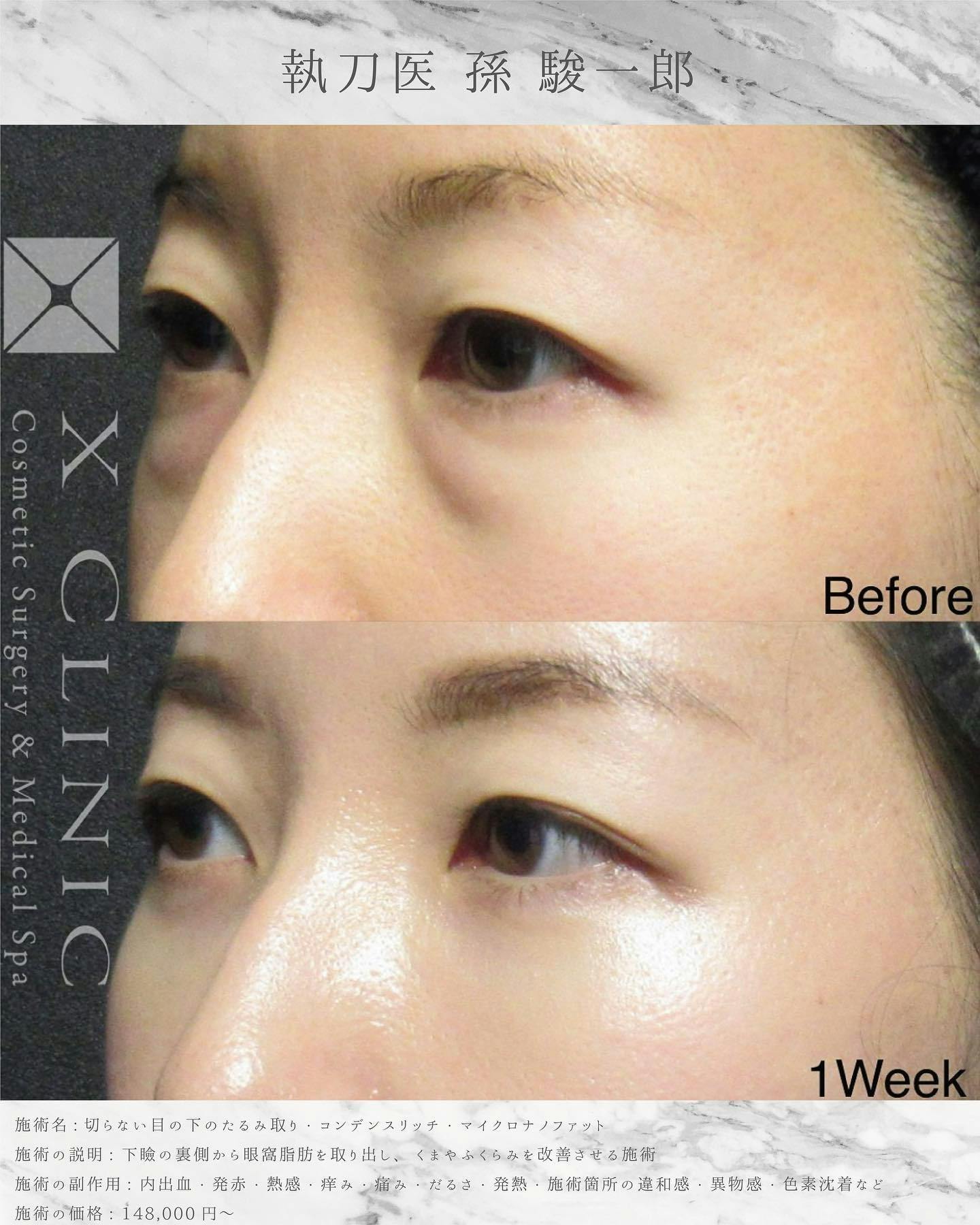 【女性・目元】クマ取りフルコース_before_aftar