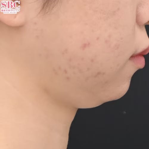 【女性・輪郭】エンブレイスRF・Aquicell（アキーセル）脂肪吸引・ボトックス_before