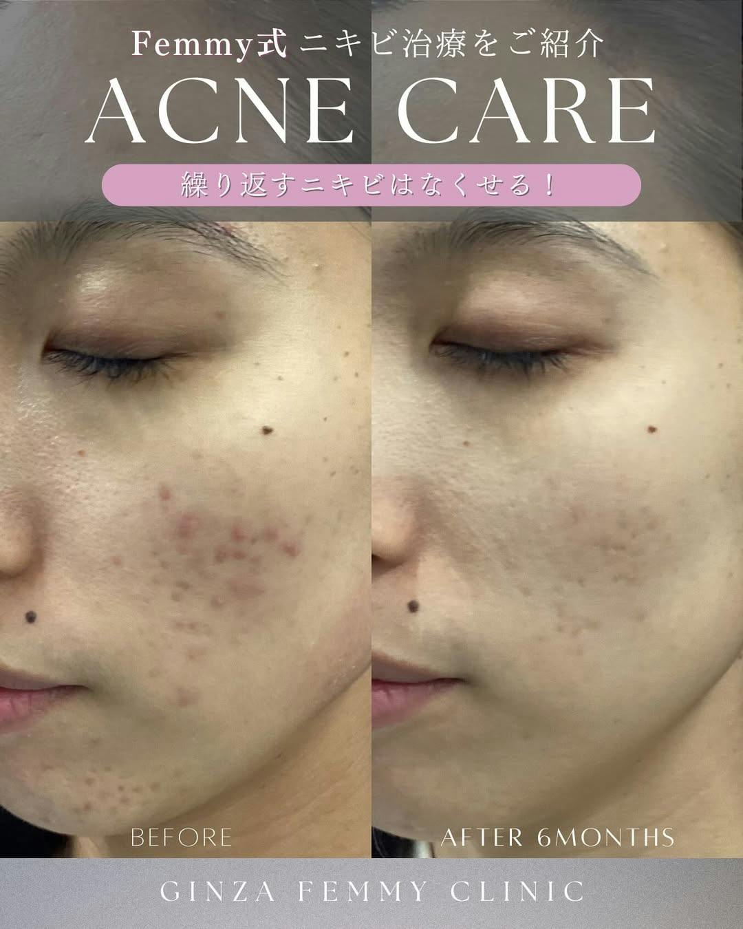 【女性・ニキビ】ニキビ治療_before_aftar