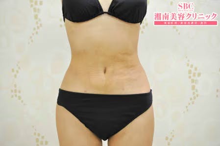 【女性・腹部】根こそぎVASER脂肪吸引、ライポマティック脂肪吸引、Aquicell（アキーセル）脂肪吸引_aftar