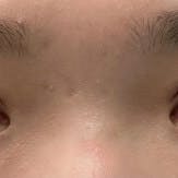 【女性・目元】週末二重(R)_1week