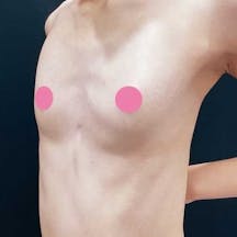 【女性・胸】週末豊胸 -ピュアグラフト-(脂肪注入豊胸)_before