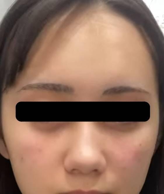 ルラ美容クリニック 渋谷本院で目の下のふくらみ取り：目の下のふくらみ取りスタンダードを受けたうちやまさんの写真