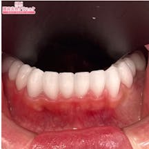 【歯】ダイヤモンドオーダーセラミック 歯肉整形_aftar