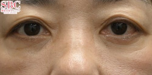 【女性・目元】切開ハムラ(表ハムラ)法 リジュランi_after