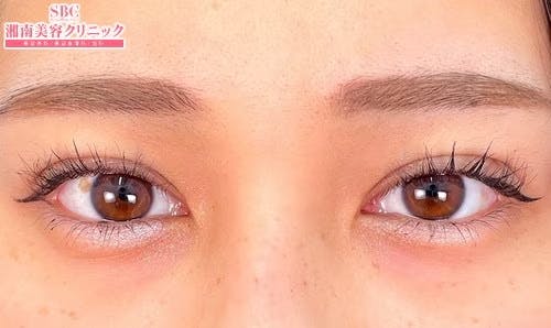 【女性・目元】クイックコスメティーク・ダブルNeo_after