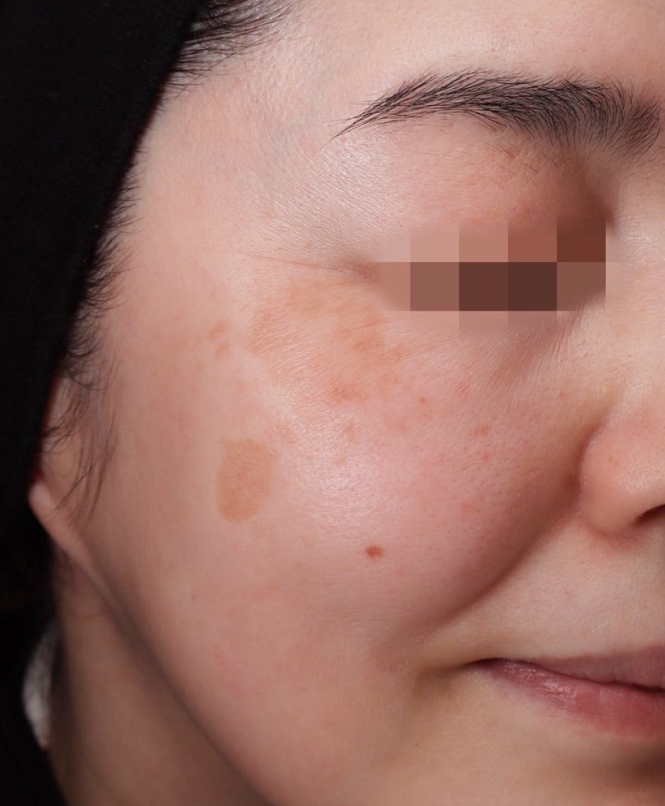 GRACY TOKYO CLINIC リポットレーザー 症例 Beforeの画像