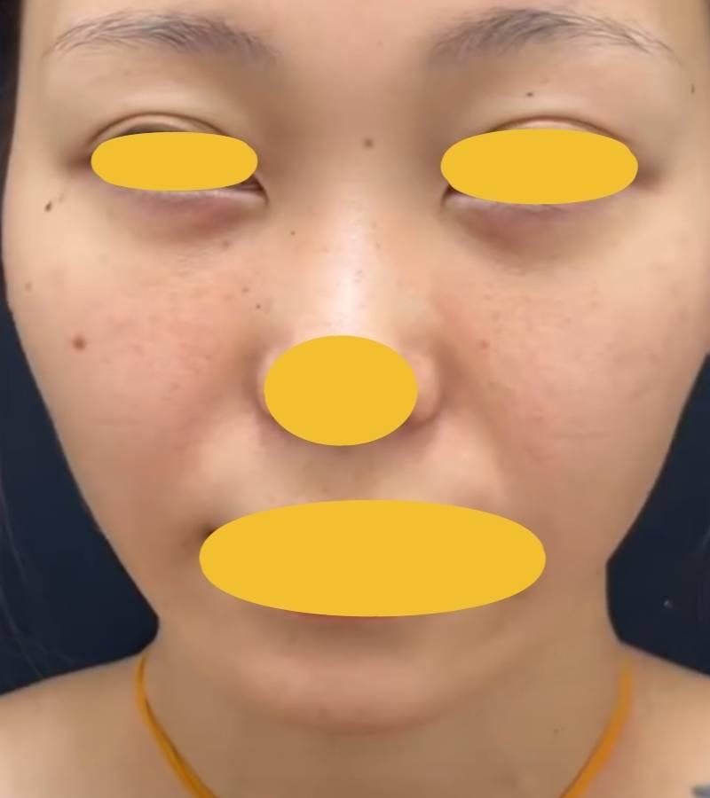 ルラ美容クリニック 名古屋院で目の下のクマ取り：目の下のクマ取りプレミアを受けたふなもさんの写真