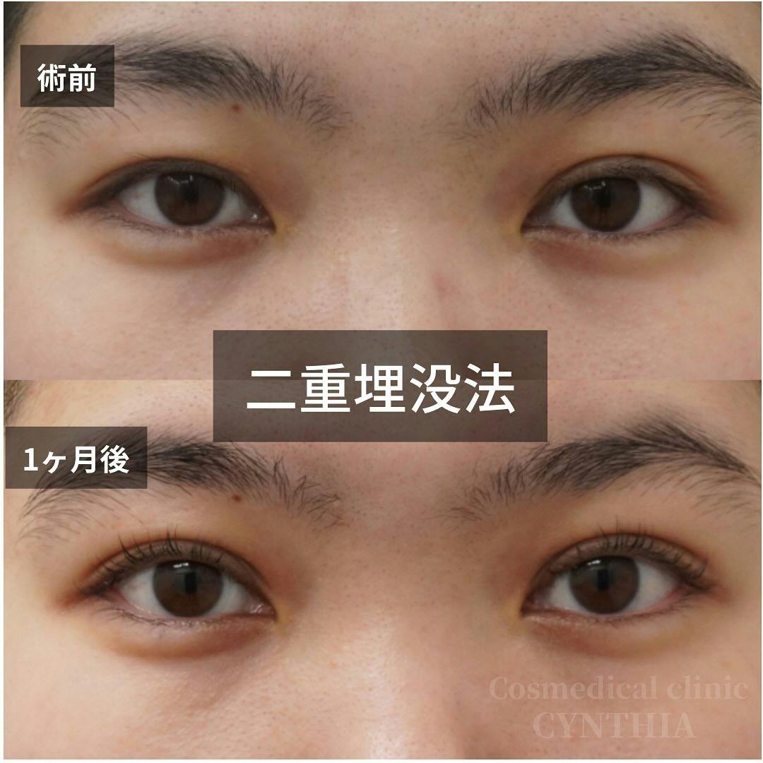 【女性・目元】二重埋没法_before_aftar