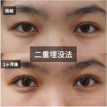 【女性・目元】二重埋没法_before_aftar