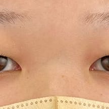 【20代女性・目元】線留めクロス二重術、自然癒着法_before