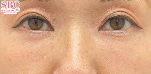 【50代女性・目元】アイバックリムーブ法、ナチュラル脂肪注射コンデンスリッチ、ナチュラル脂肪注射ナノリッチ_1month