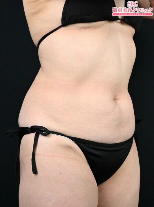 【50代女性・腹部】ダイエット注射 MITI（マイティ）_before