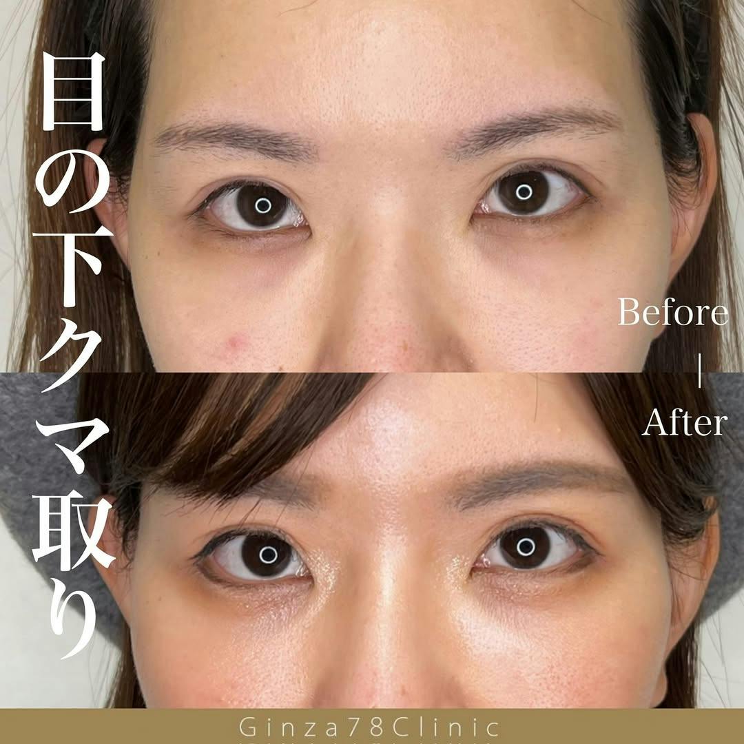 【女性・目元】目の下のクマ取り_before_aftar