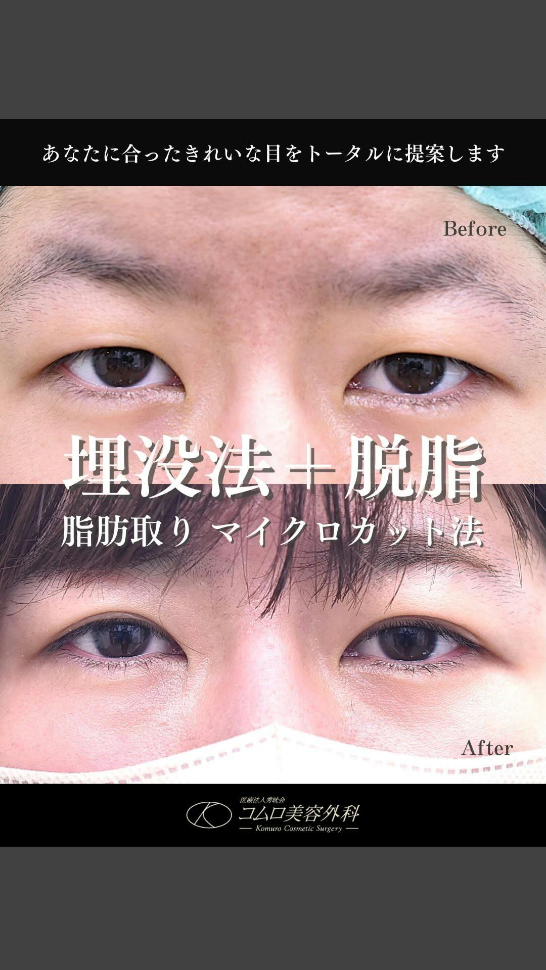【20代女性・目元】埋没法＋脱脂（マイクロカット法）_before_aftar