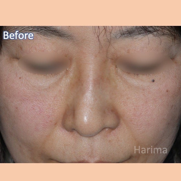 【女性・鼻】斜鼻・鼻閉手術_before