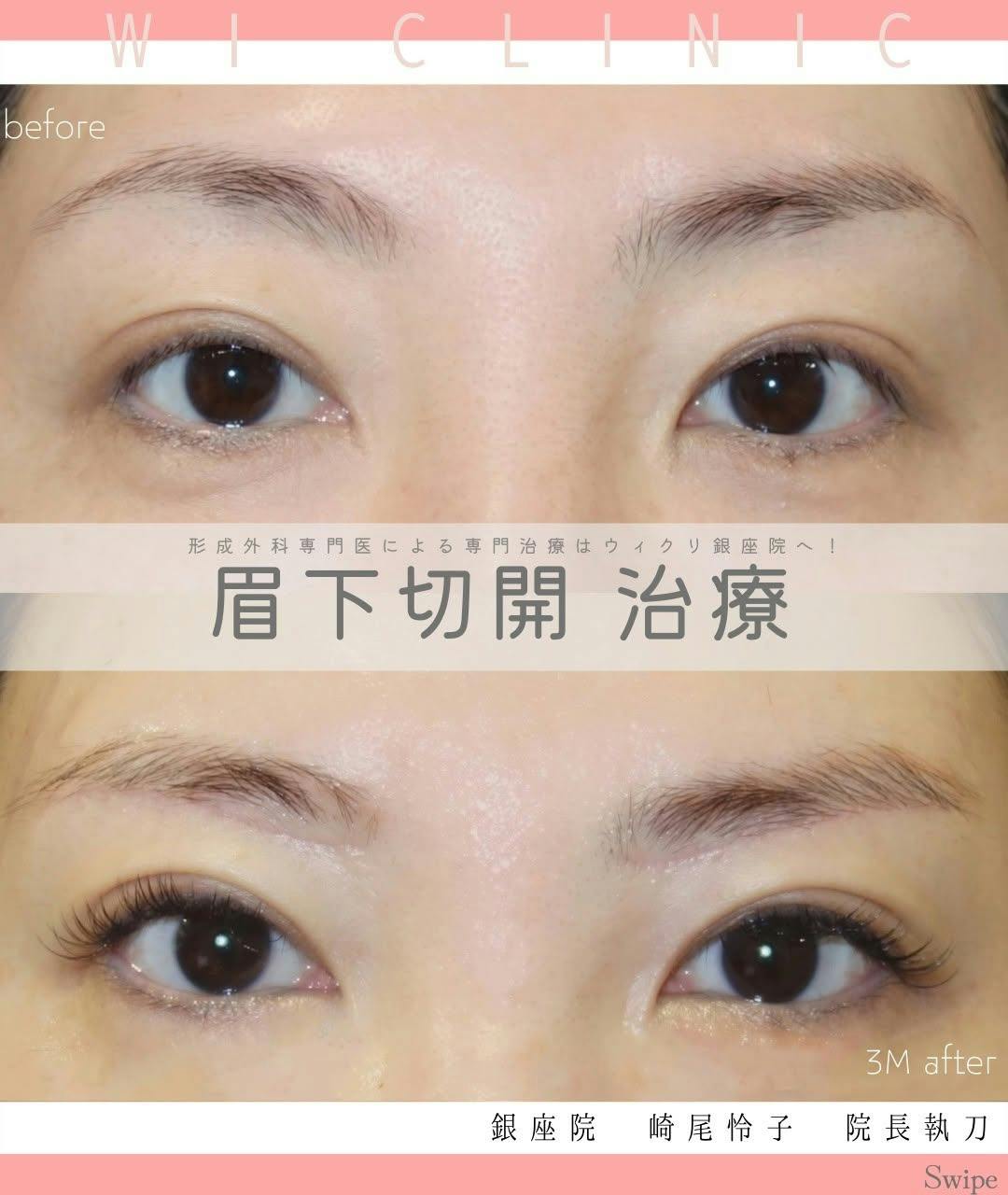 【女性・目元】眉下切開_before_aftar