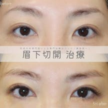 【女性・目元】眉下切開_before_aftar