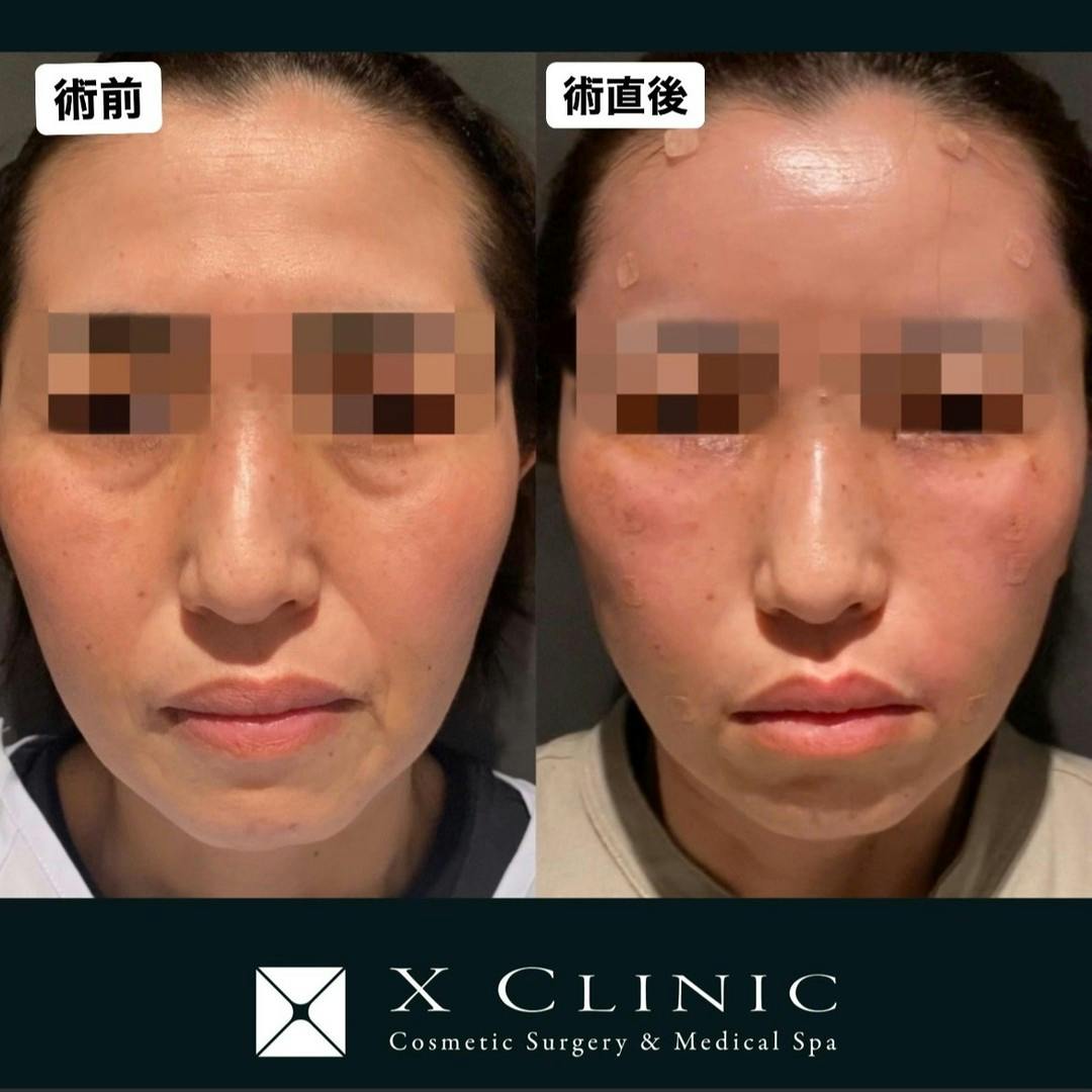 【女性・顔】糸リフト くまとりフルコース 額こめかみ法令線脂肪注入_before_aftar