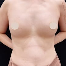 【女性・胸】週末豊胸 -ピュアグラフト-(脂肪注入豊胸)_after