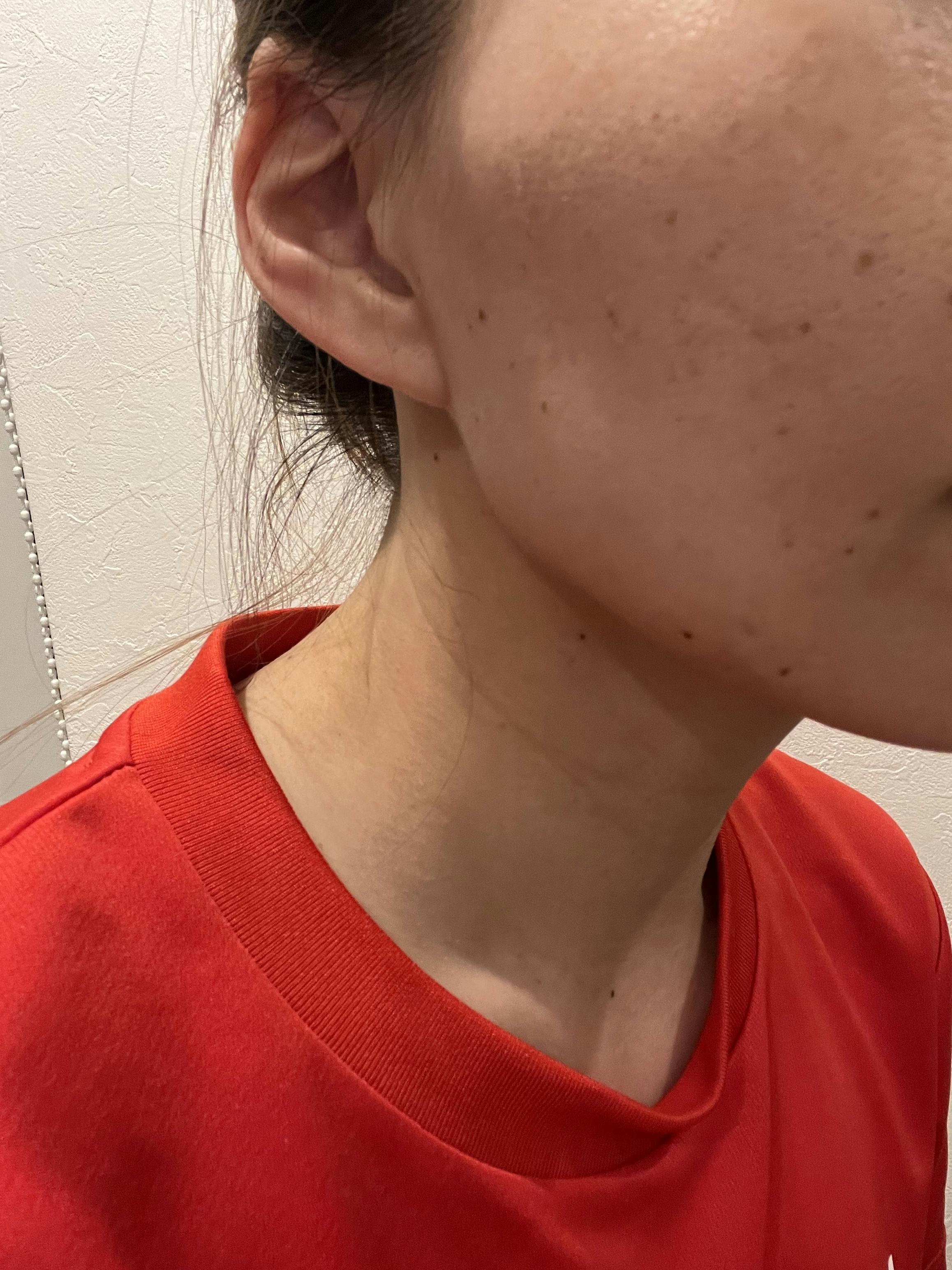 湘南美容クリニック 奈良院でを受けたmちゃんさんの写真