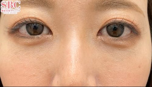 【30代女性・目元】裏ハムラ法 ナチュラル脂肪注射ナノリッチ VOV（ボブ）リフト_aftar