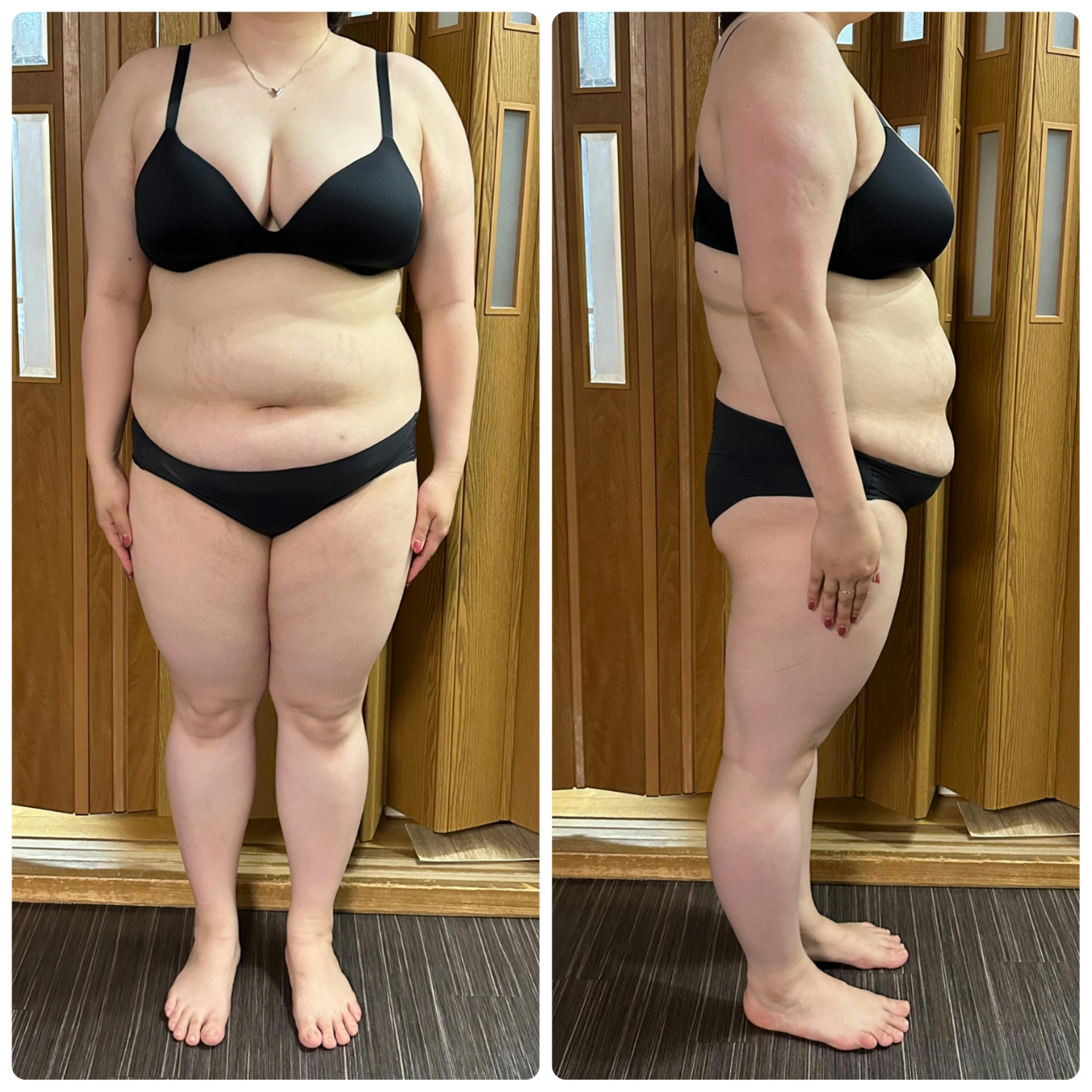 湘南美容クリニック 大阪梅田本院で医療痩身・ダイエット・GLP-1・サクセンダを受けたnaagiiさんの写真