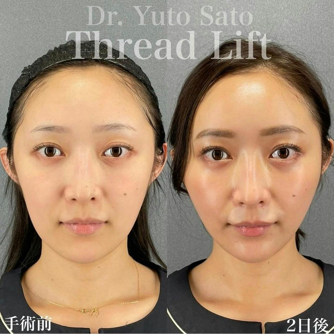 【女性・輪郭】糸リフト(Y LIFT Standard)_before_aftar