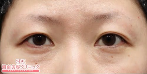 【女性・目元】眼瞼下垂＋二重、目の下の切らないクマ・たるみ（ふくらみ）取り_before