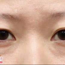 【女性・目元】眼瞼下垂+二重、目の下の切らないクマ・たるみ(ふくらみ)取り_before