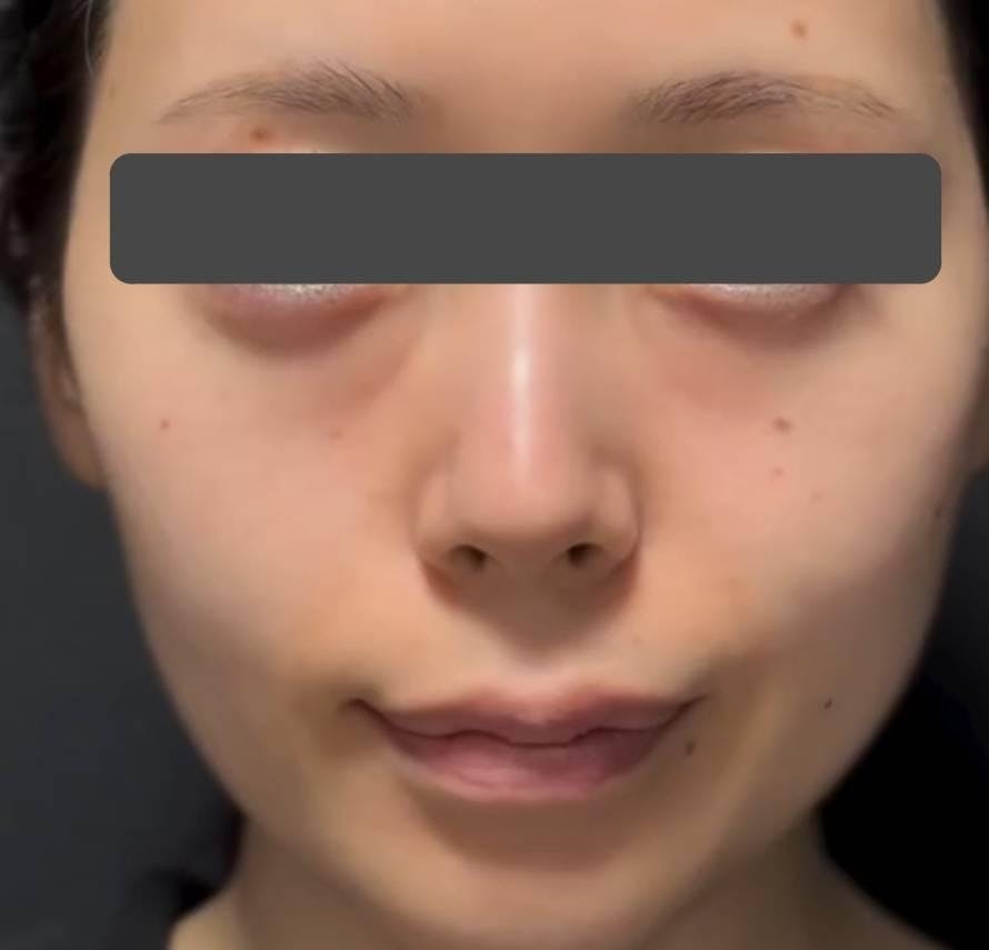 湘南美容クリニック 広島院で目の下の切らないクマ取り+ヒアルロン酸注入：裏ハムラ法、ヒアルロン酸注入を受けたビーバーさんの写真