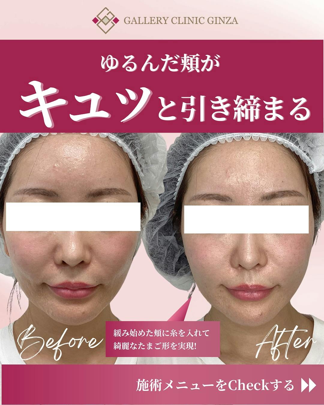 【女性・たるみ】ショートスレッド(糸リフト)_before_aftar