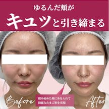 【女性・たるみ】ショートスレッド(糸リフト)_before_aftar